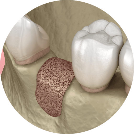 bone grafting model