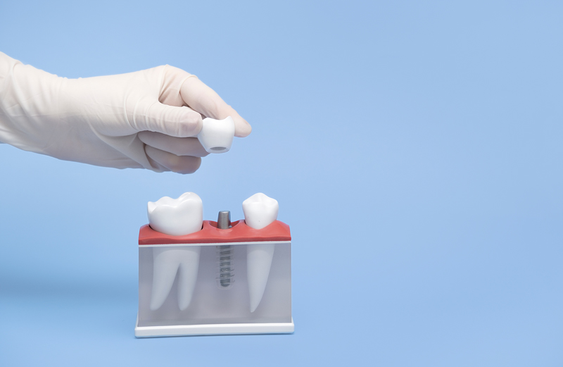 A hand in a white glove holds a model of a tooth implant blue table and background.A hand in a white glove holds a model of a tooth implant blue table and background.