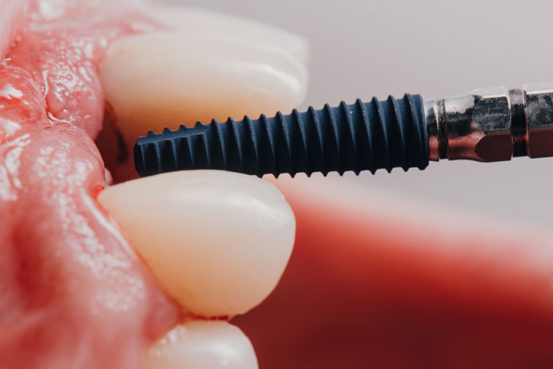DENTAL IMPLANT EXAMPLE ON REAl TEETH.