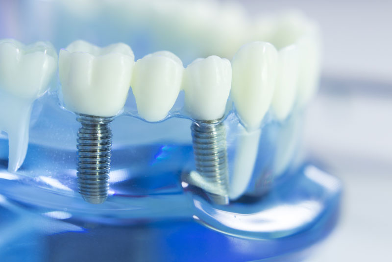 dental implants.