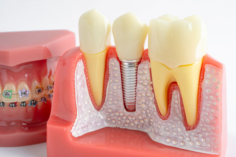 Dental implant, artificial tooth roots into jaw, root canal of dental treatment, gum disease, teeth model for dentist studying about dentistry.
