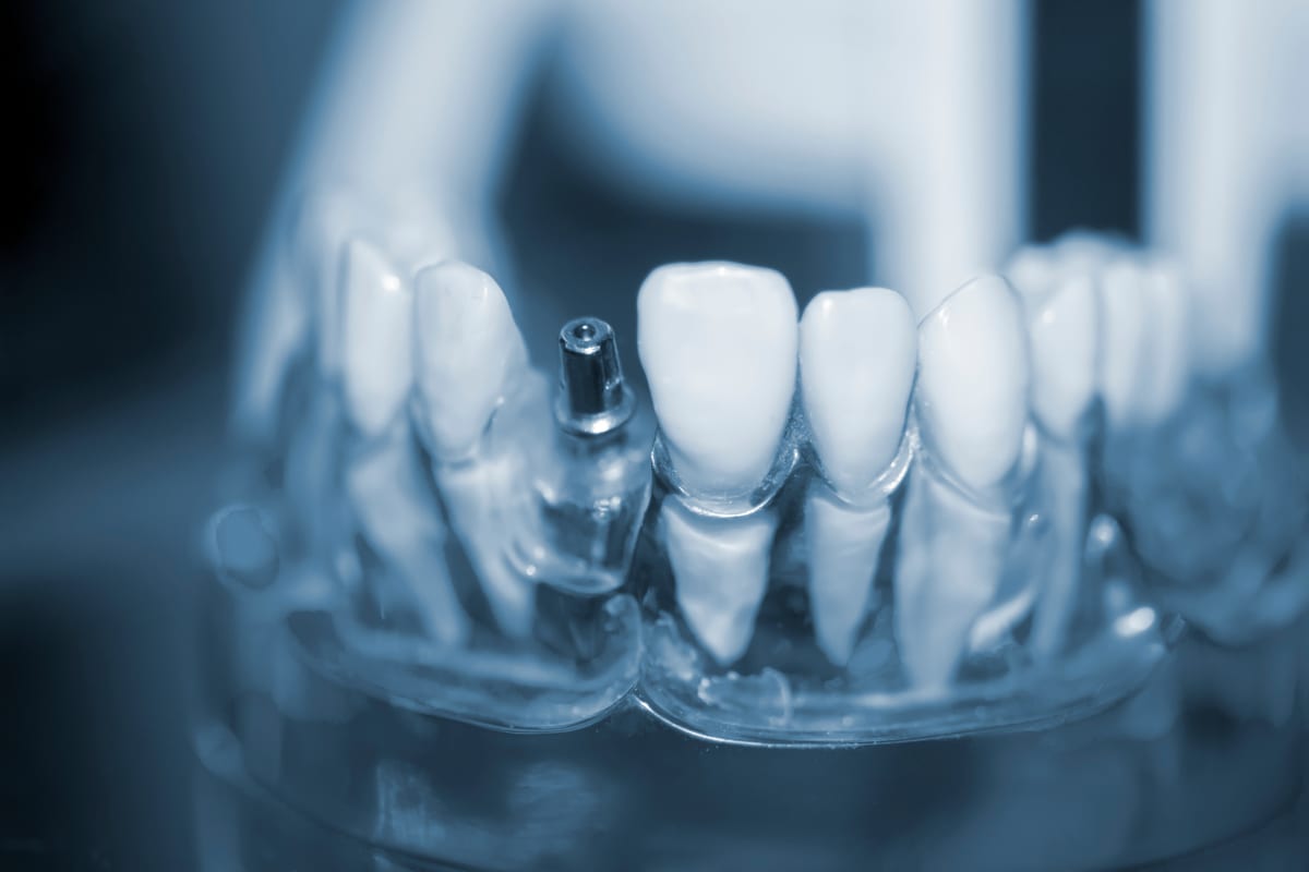 An infographic comparing the different options for replacing a missing tooth, including a dental implant, fixed bridge, and removable partial denture. The graphic should be visually appealing and informative, with brief descriptions of each option. No Text on Image.